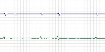 Electrocardiogram for MIT-BIH Supraventricular Arrhythmia, record 828
