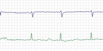 Electrocardiogram for MIT-BIH Supraventricular Arrhythmia, record 829