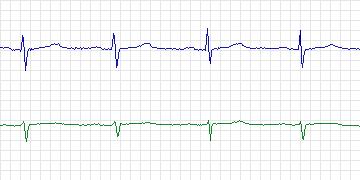 Electrocardiogram for MIT-BIH Supraventricular Arrhythmia, record 840