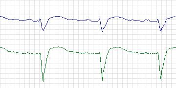 Electrocardiogram for MIT-BIH Supraventricular Arrhythmia, record 841