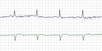Electrocardiogram for MIT-BIH Supraventricular Arrhythmia, record 842