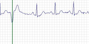 Electrocardiogram for MIT-BIH Supraventricular Arrhythmia, record 843