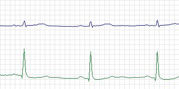 Electrocardiogram for MIT-BIH Supraventricular Arrhythmia, record 844