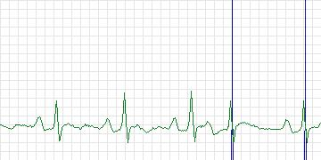 Electrocardiogram for MIT-BIH Supraventricular Arrhythmia, record 845