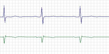 Electrocardiogram for MIT-BIH Supraventricular Arrhythmia, record 846
