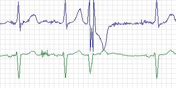 Electrocardiogram for MIT-BIH Supraventricular Arrhythmia, record 847