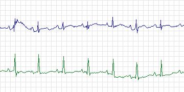 Electrocardiogram for MIT-BIH Supraventricular Arrhythmia, record 848
