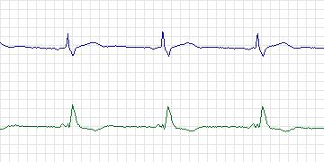 Electrocardiogram for MIT-BIH Supraventricular Arrhythmia, record 849