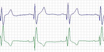 Electrocardiogram for MIT-BIH Supraventricular Arrhythmia, record 850