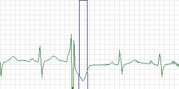Electrocardiogram for MIT-BIH Supraventricular Arrhythmia, record 851