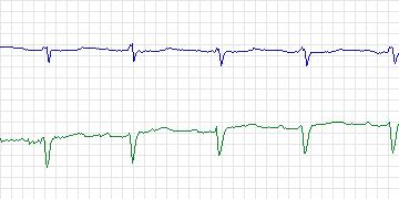 Electrocardiogram for MIT-BIH Supraventricular Arrhythmia, record 852