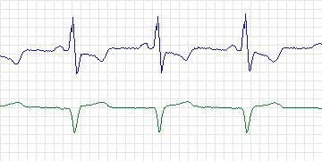 Electrocardiogram for MIT-BIH Supraventricular Arrhythmia, record 853