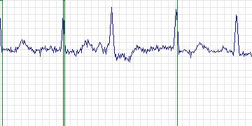 Electrocardiogram for MIT-BIH Supraventricular Arrhythmia, record 854
