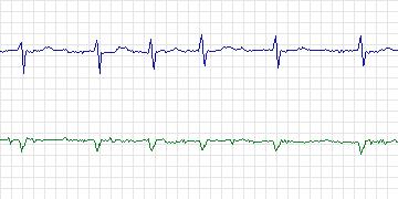 Electrocardiogram for MIT-BIH Supraventricular Arrhythmia, record 855