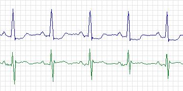 Electrocardiogram for MIT-BIH Supraventricular Arrhythmia, record 856