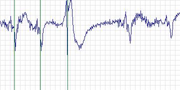Electrocardiogram for MIT-BIH Supraventricular Arrhythmia, record 857