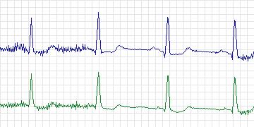 Electrocardiogram for MIT-BIH Supraventricular Arrhythmia, record 858