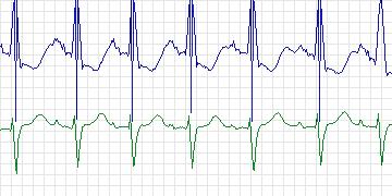 Electrocardiogram for MIT-BIH Supraventricular Arrhythmia, record 859