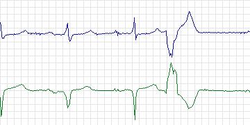 Electrocardiogram for MIT-BIH Supraventricular Arrhythmia, record 860