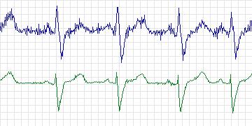 Electrocardiogram for MIT-BIH Supraventricular Arrhythmia, record 861