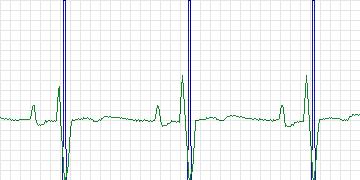 Electrocardiogram for MIT-BIH Supraventricular Arrhythmia, record 862