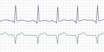 Electrocardiogram for MIT-BIH Supraventricular Arrhythmia, record 863