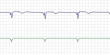 Electrocardiogram for MIT-BIH Supraventricular Arrhythmia, record 864