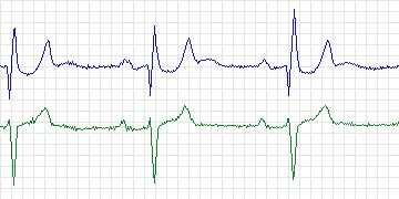 Electrocardiogram for MIT-BIH Supraventricular Arrhythmia, record 865