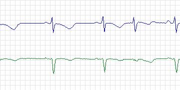 Electrocardiogram for MIT-BIH Supraventricular Arrhythmia, record 866
