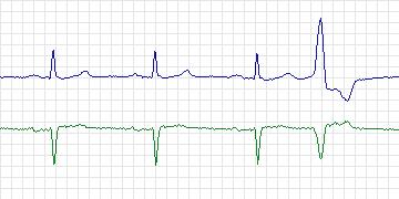 Electrocardiogram for MIT-BIH Supraventricular Arrhythmia, record 887