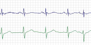 Electrocardiogram for MIT-BIH Supraventricular Arrhythmia, record 888