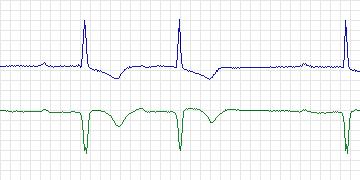 Electrocardiogram for MIT-BIH Supraventricular Arrhythmia, record 889