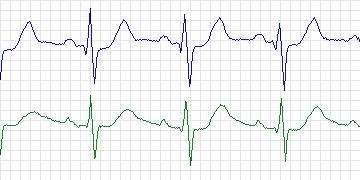 Electrocardiogram for MIT-BIH Supraventricular Arrhythmia, record 890