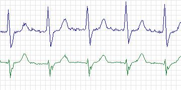 Electrocardiogram for MIT-BIH Supraventricular Arrhythmia, record 891