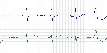 Electrocardiogram for MIT-BIH Supraventricular Arrhythmia, record 892