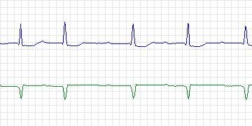 Electrocardiogram for MIT-BIH Supraventricular Arrhythmia, record 893