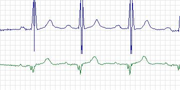 Electrocardiogram for MIT-BIH Supraventricular Arrhythmia, record 894