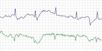 Electrocardiogram for T-Wave Alternans Challenge, record twa02