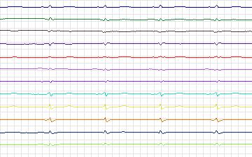 Electrocardiogram for T-Wave Alternans Challenge, record twa03