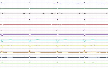 Electrocardiogram for T-Wave Alternans Challenge, record twa11