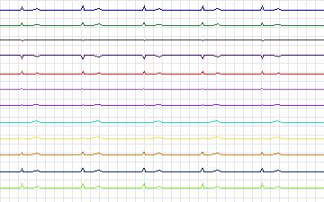 Electrocardiogram for T-Wave Alternans Challenge, record twa13