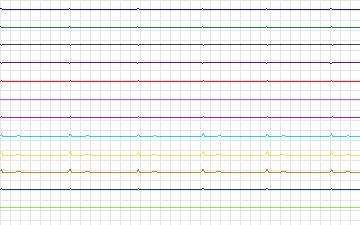 Electrocardiogram for T-Wave Alternans Challenge, record twa15