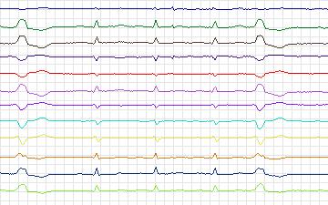 Electrocardiogram for T-Wave Alternans Challenge, record twa16