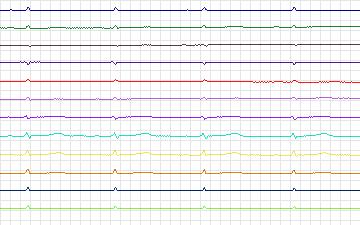 Electrocardiogram for T-Wave Alternans Challenge, record twa18
