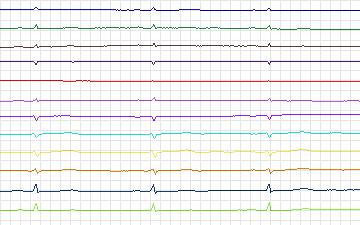 Electrocardiogram for T-Wave Alternans Challenge, record twa44