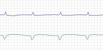 Electrocardiogram for T-Wave Alternans Challenge, record twa45