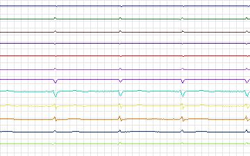 Electrocardiogram for T-Wave Alternans Challenge, record twa48