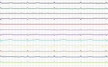 Electrocardiogram for T-Wave Alternans Challenge, record twa49