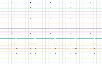 Electrocardiogram for T-Wave Alternans Challenge, record twa50