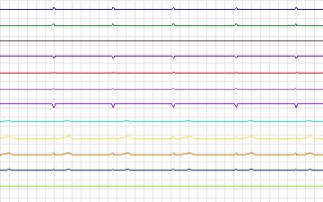 Electrocardiogram for T-Wave Alternans Challenge, record twa51